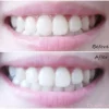 Crest 3D White Whitestrips Gentle Routine – Kit blanchiment