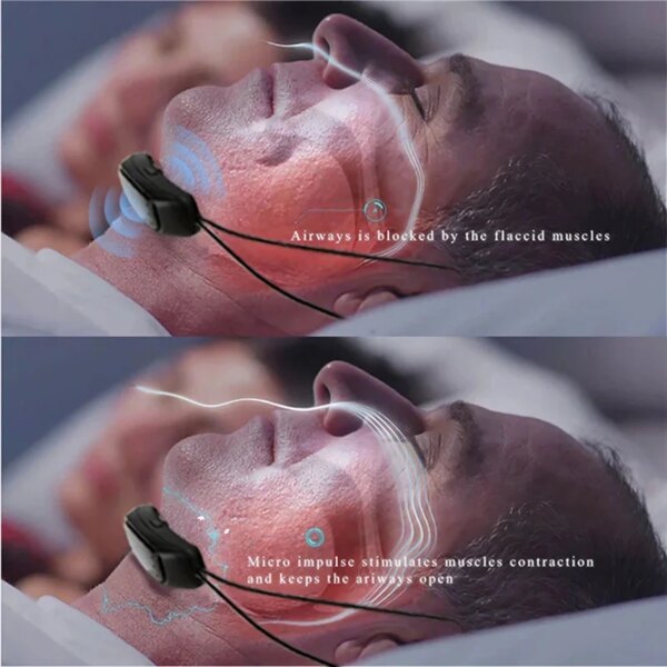 17547-56f238.jpg Dispositif anti-ronflement intelligent portable, solution efficace, arrêt du pouls, amélioration du sommeil