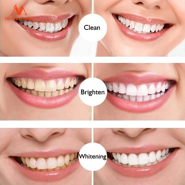 Stylo de Blanchiment Dentaire 5ml – Sérum Nettoyant