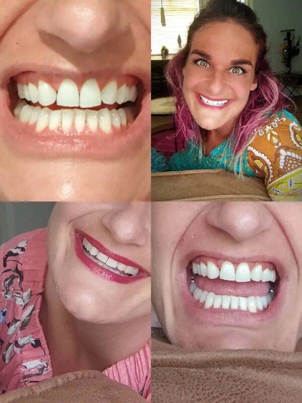 kit blanchiment dentaire Gel de blanchiment des dents 44% peroxyde