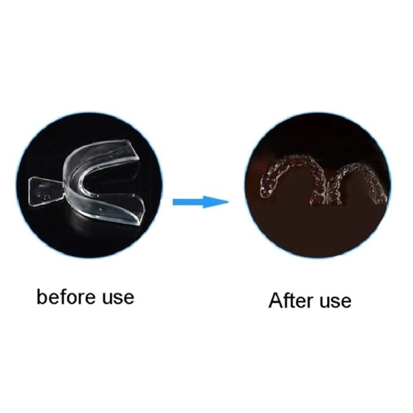 Protège-Dents Silicone Thermoformable – Anti-Bruxisme & Aide au Sommeil