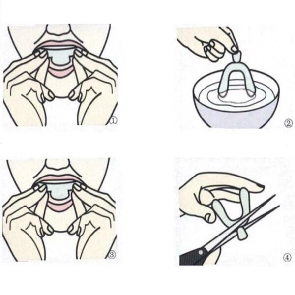 Protège-dents / Gouttière dentaire temporaire flexible – Ajustement confortable