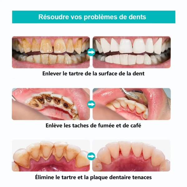 détartrage dentaire, dissolvant de tartre dentaire, nettoyage Ultra sonique