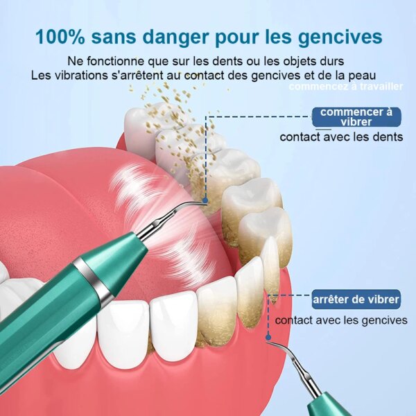 détartrage dentaire, dissolvant de tartre dentaire, nettoyage Ultra sonique