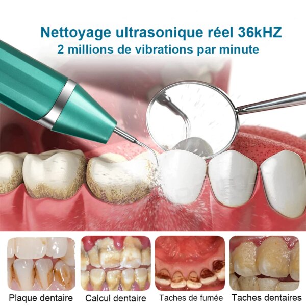 détartrage dentaire, dissolvant de tartre dentaire, nettoyage Ultra sonique