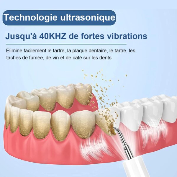 détartrage dentaire pour retirer le tartre dentaire