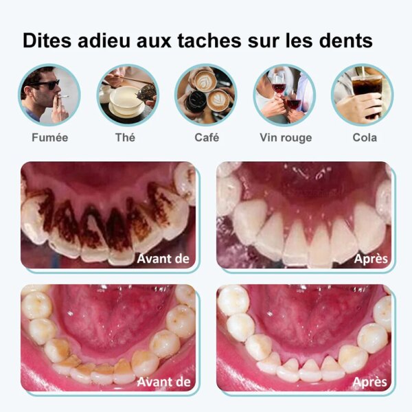 détartrage dentaire électrique sonique de tartre dentaire