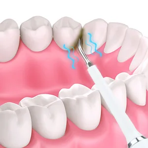 8265-faa29f.jpg détartrage dentaire électrique sonique, dissolvant de tartre dentaire